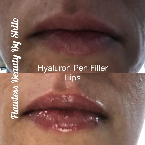 Hyaluron Pen Fillers